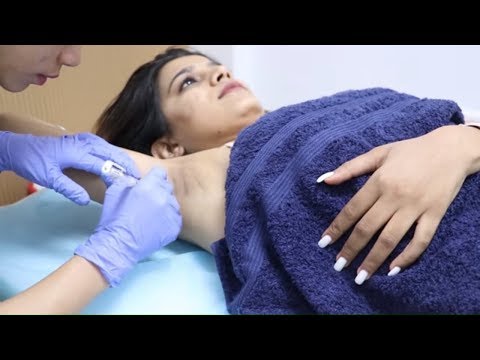 Laser Hair Removal | Underarms + Bikini | Permanent Hair Removal Treatment | super Style Tips